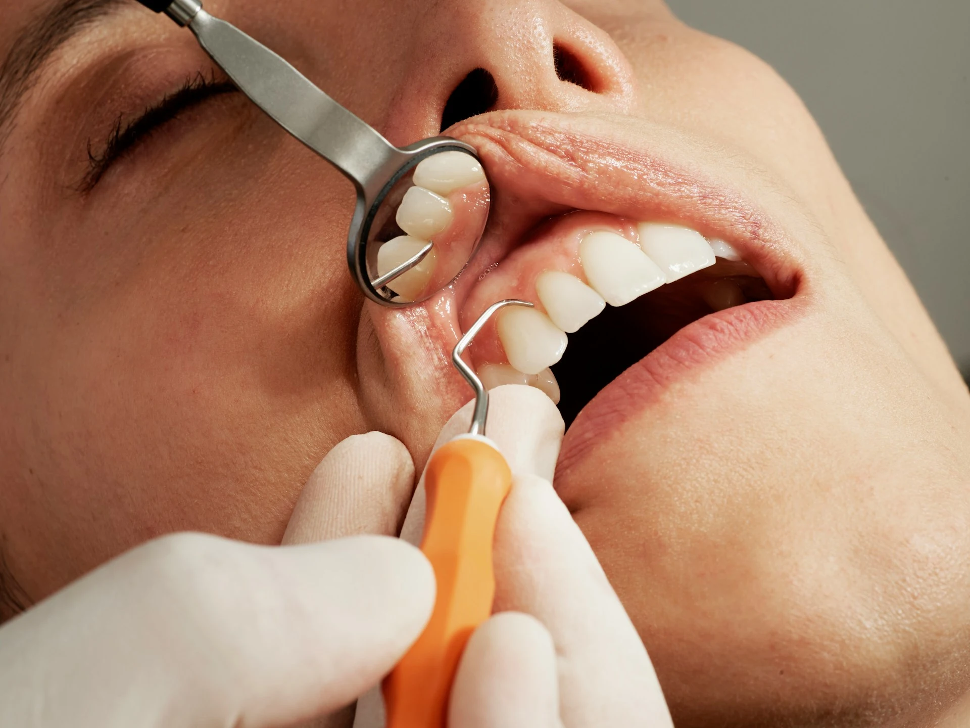 Tratamento Periodontal e Gengival