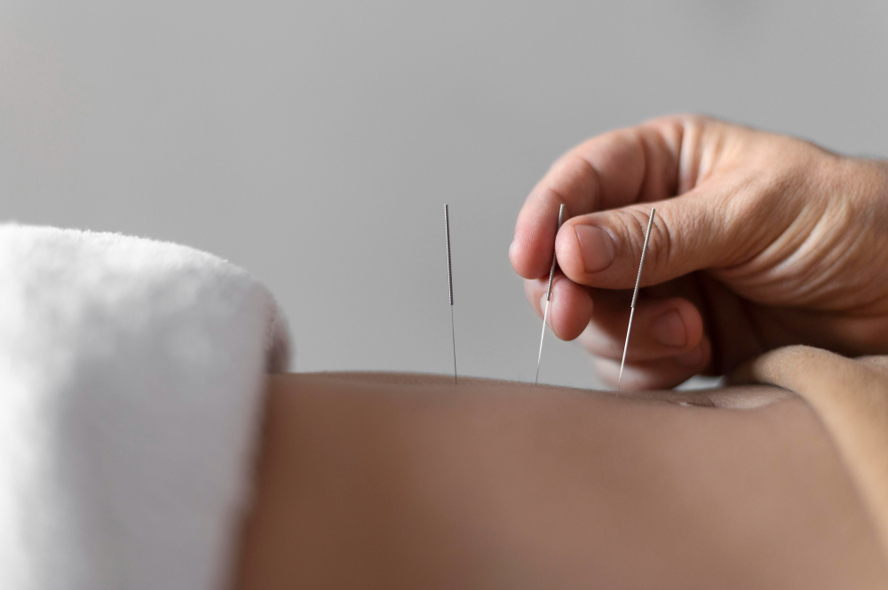 Sessão de Acupuntura Clínica